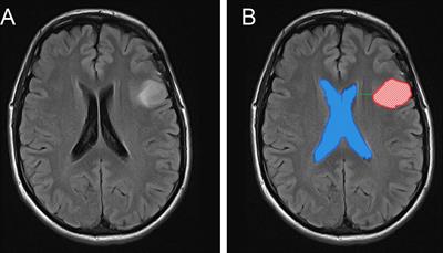 Combination of the Distance From Tumor Edge to Subventricular Zone and IDH Mutation Predicts Prognosis of Patients With Glioma